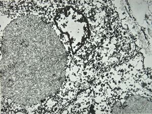 M,67y. | alcoholic hyalin (Mallory body) … autopsy sample M,67y. | alcoholic hyalin (Mallory body) … autopsy sample